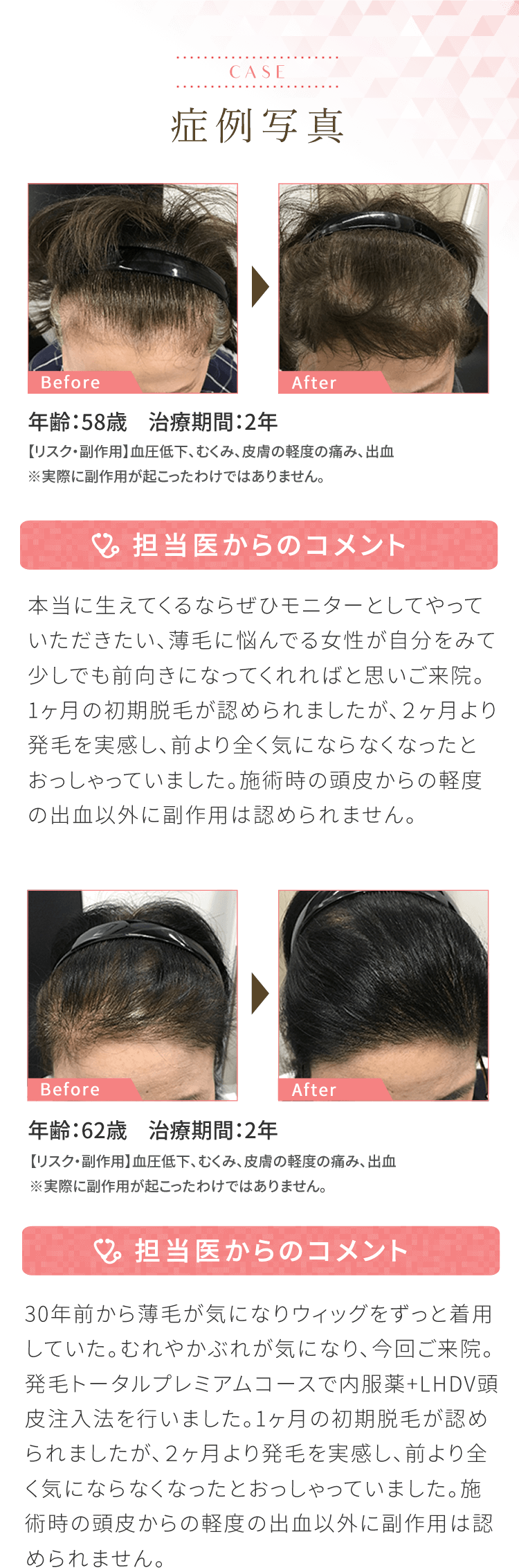 症例写真　年齢：44歳　治療期間1年[担当医からのコメント]前頭部、後頭部にかけてAGA進行でお悩みでした。日常生活ではカツラを使用していたところ、自身の髪を取り戻したいとのことでご来院くださいました。内服薬＋LDHV頭皮注入法を実施。初脱毛は1ヶ月未満で収まり、2ヶ月目より発毛をご実感いただきました。実施時の頭皮からの軽度の出血以外に副作用は認められませんでした。　年齢：32歳　治療期間2年[担当医からのコメント]長年薄毛に悩まされており、お子様が生まれる前に改善したいと思いご来院いただきました。1ヶ月間の初期脱毛が認められましたが、2ヶ月目より発毛をご実感。施術時の頭皮からの軽度の出血以外に副作用は認められませんでした。