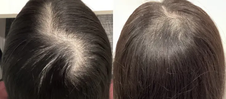 治療前（20代）