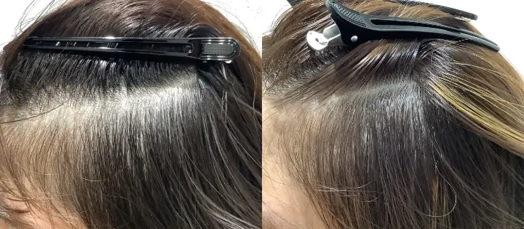 治療前（20代）