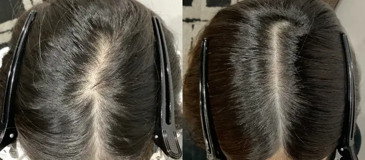 治療前（20代）