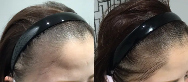 治療前（20代）