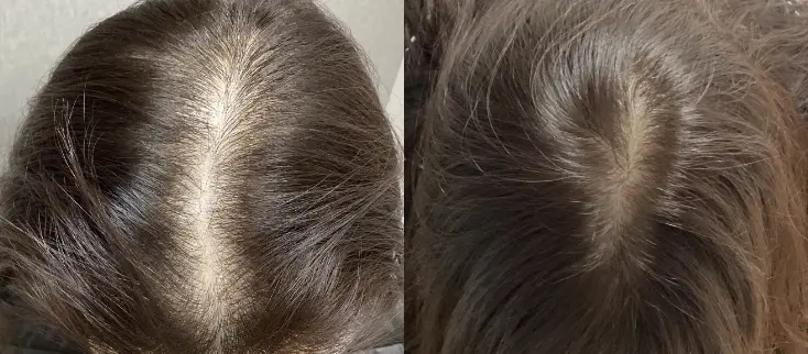 治療前（20代）