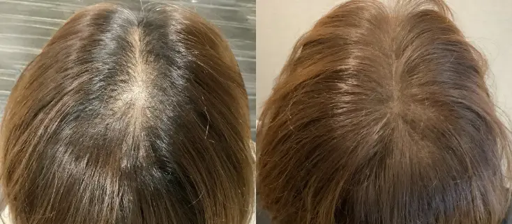 治療前（20代）