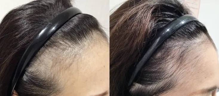 治療前（20代）