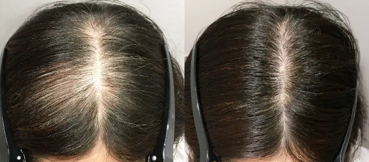 治療前（20代）