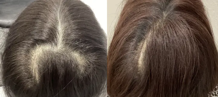 治療前（20代）