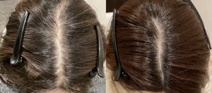 治療前（20代）