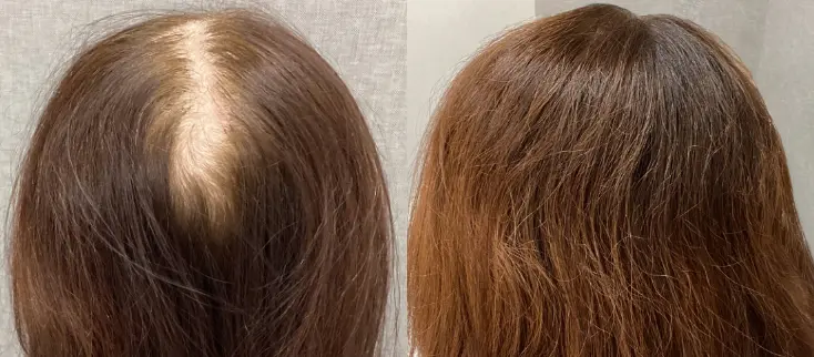 治療前（20代）