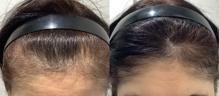 治療前（20代）