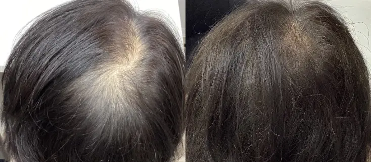 治療前（20代）