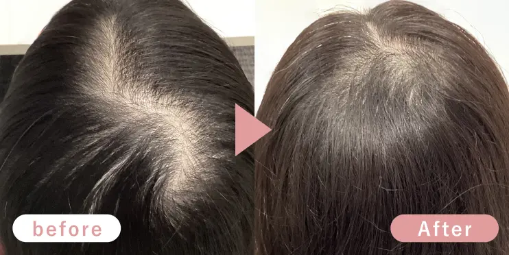 20代女性頭頂部症例