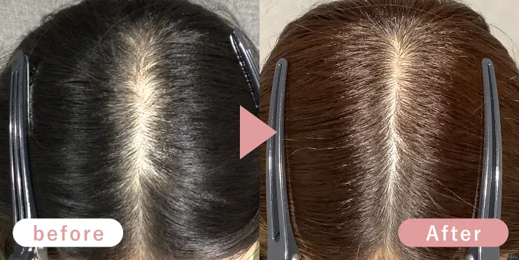 20代女性分け目症例