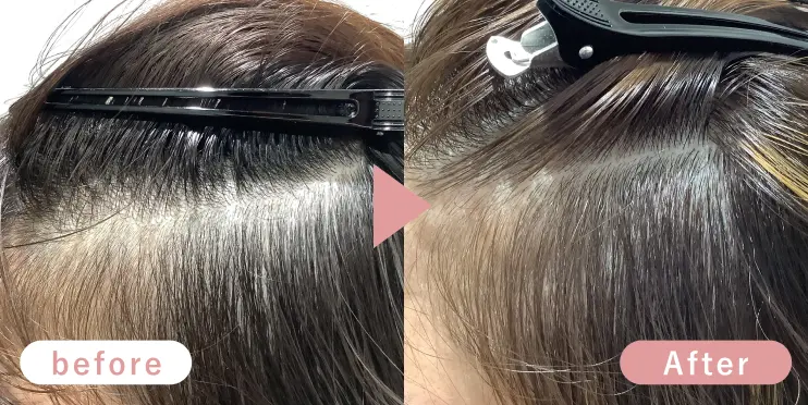 20代女性生え際症例