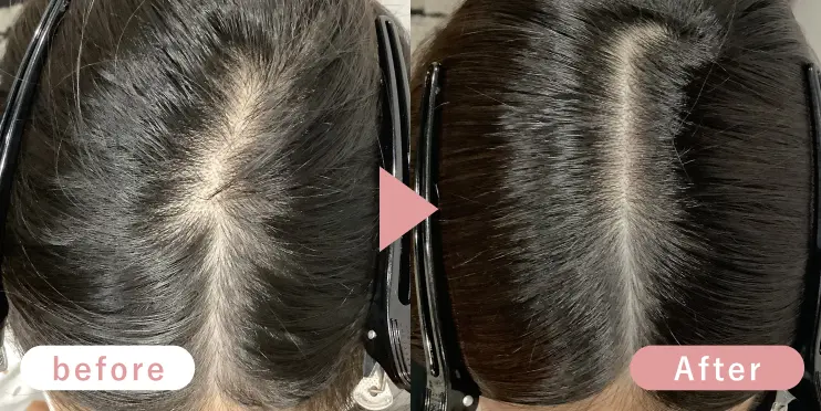 30代女性分け目症例