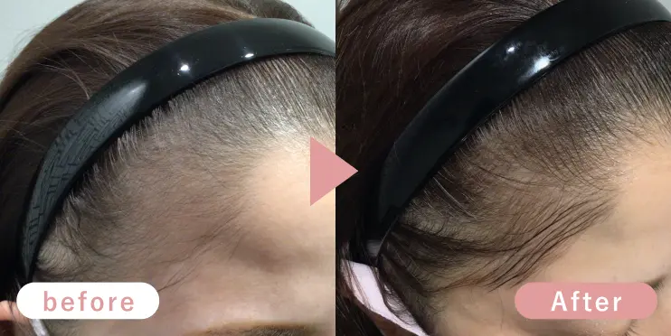 30代女性生え際症例