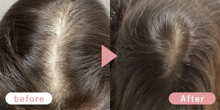 30代女性頭頂部症例