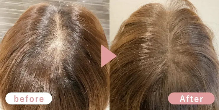 40代女性頭頂部症例