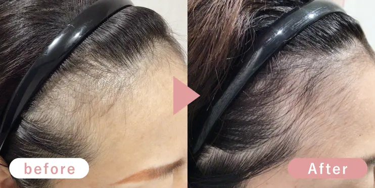 40代女性生え際症例