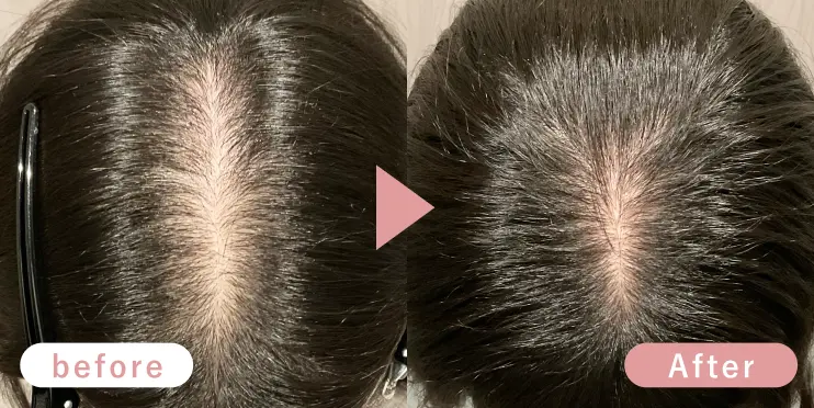 40代女性頭頂部症例