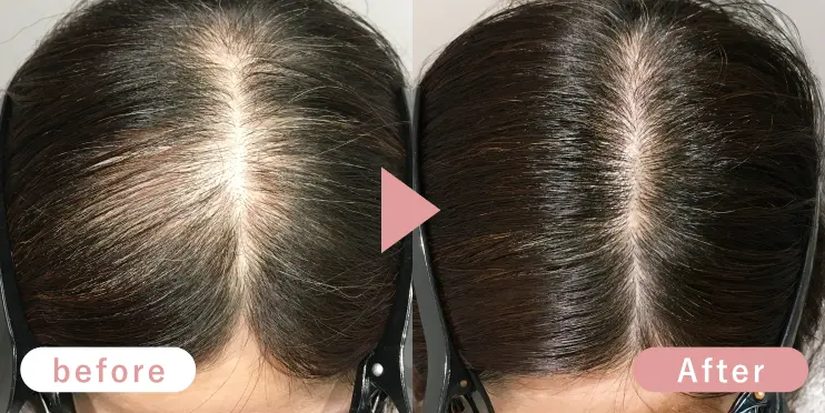 50代女性頭頂部症例