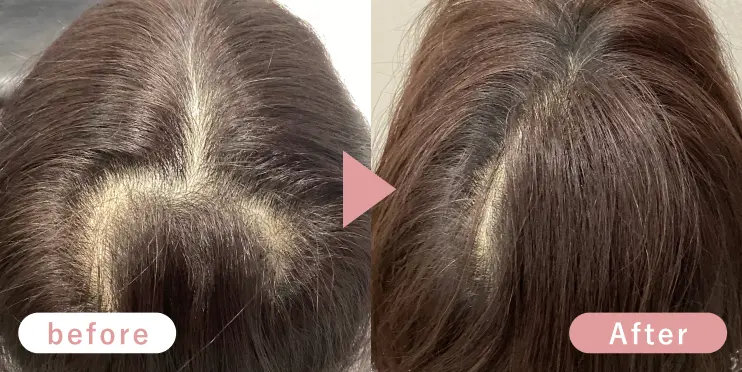 50代女性頭頂部症例