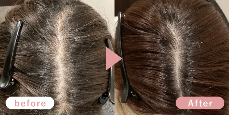 50代女性分け目症例