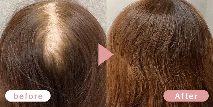 60代女性頭頂部症例