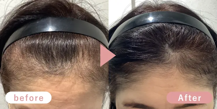 60代女性生え際症例