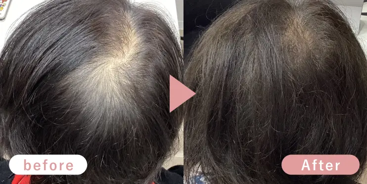 60代女性頭頂部症例