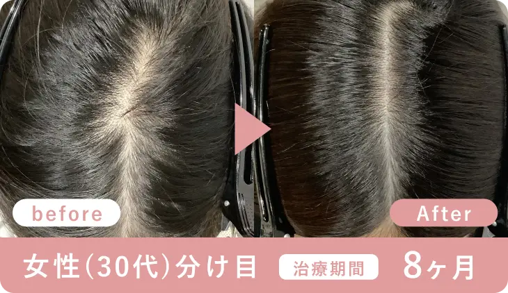 女性30代、分け目、治療期間8ヶ月の症例