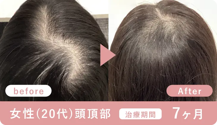 女性20代、頭頂部、治療期間7ヶ月の症例