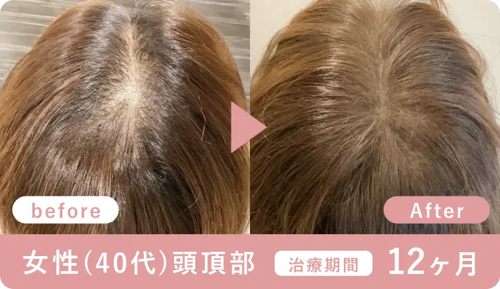 女性40代、頭頂部、治療期間12ヶ月の症例