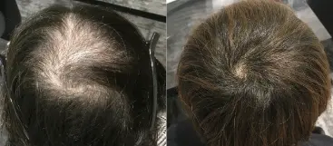 治療前（20代）