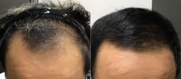 治療前（20代）