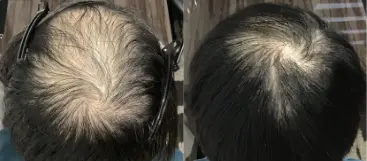 治療前（20代）