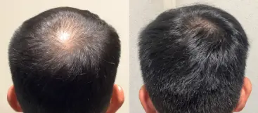 治療前（20代）