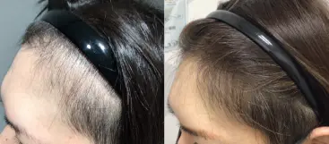 治療前（20代）