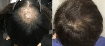 治療前（20代）