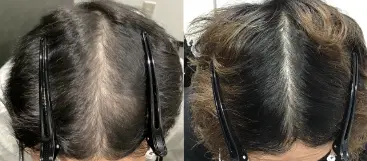 治療前（20代）