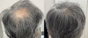 治療前（20代）