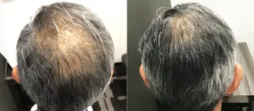 治療前（20代）