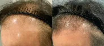 治療前（20代）