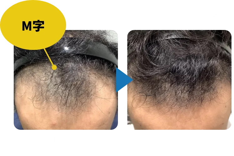 29歳男性、AGA治療1年11ヶ月のM字症例