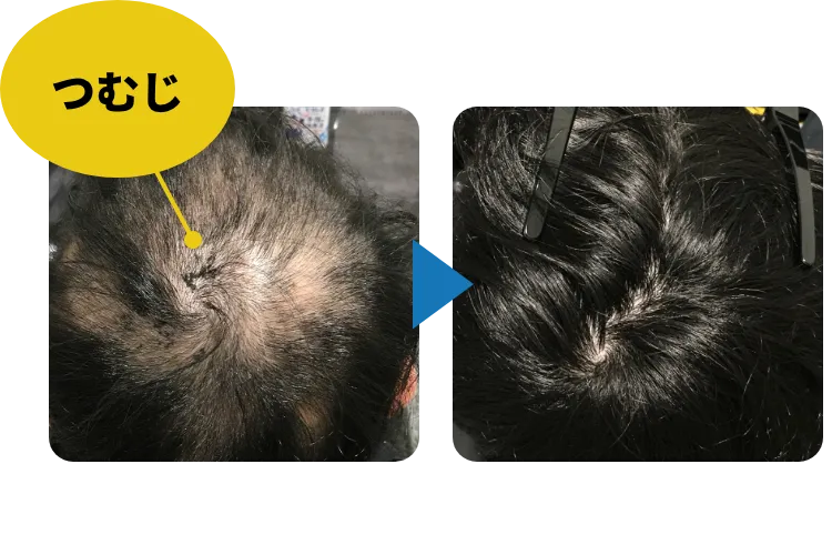 25歳男性、AGA治療11ヶ月のつむじ症例