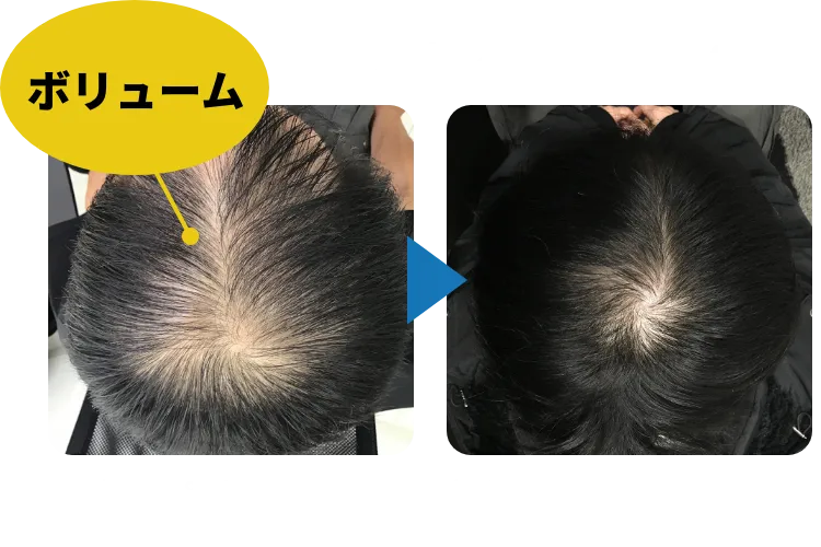 32歳男性、AGA治療8ヶ月のボリューム症例