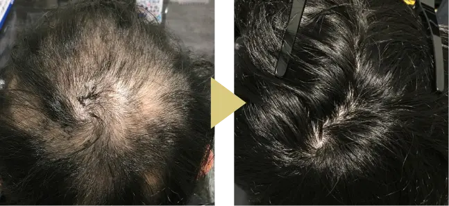 25歳男性、AGA治療11ヶ月のつむじ症例