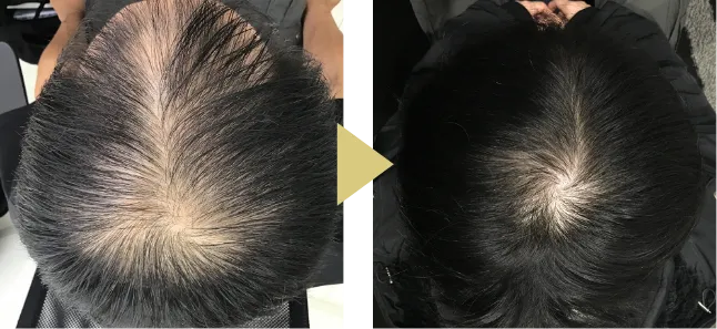 32歳男性、AGA治療8ヶ月のボリュームの症例