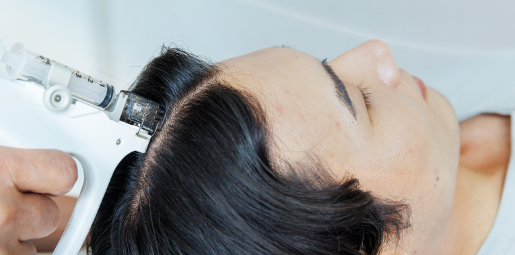 LHDV頭皮注入治療