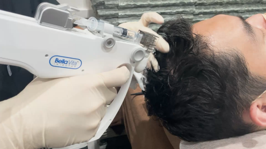 LHDV頭皮注入治療