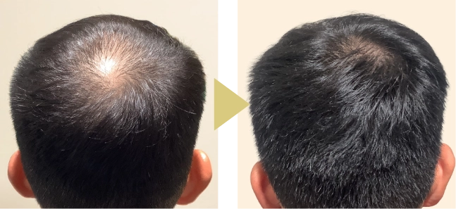 33歳男性、AGA治療12ヶ月のつむじ症例